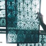 A Persistent Pesticide Is Linked to Alzheimer’s Risk