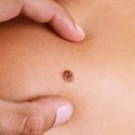 Metastatic Melanoma: Symptoms, Stages, Treatment Metastatic Melanoma: Symptoms, Stages, Treatment