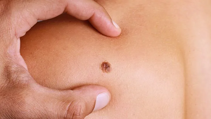 Metastatic Melanoma: Symptoms, Stages, Treatment