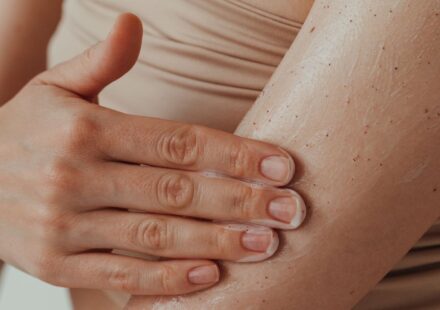 10 Beauty Products and Treatments That Can Trigger a Psoriasis Flare